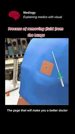 💨 Draining the Lungs: The Process of Removing Fluid (Thoracentesis) 🩺