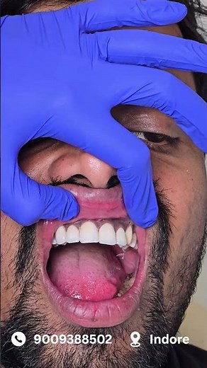 Zirconia Caps Transformation 😍 Smile Correction Result! | Indore
