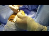 Male Rhinoplasty for Droopy and Crooked Nose  • Video • MEDtube.net