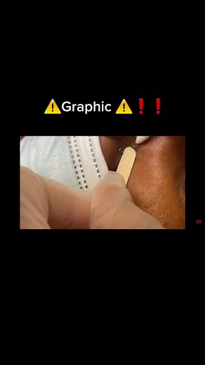 ⚠️Graphic ⚠️❗❗#pimple #extractions #pimplepopping_addiction #pimpleremover #pimplepop #fypシ