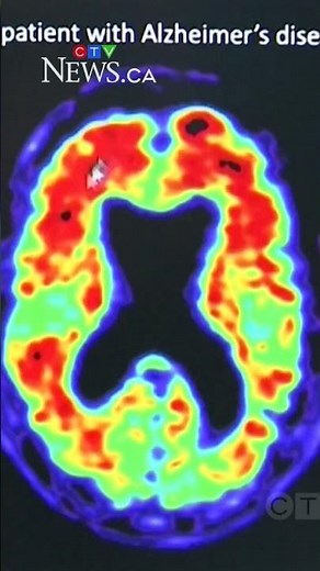 Health Canada approves drug that may slow the progression of dementia