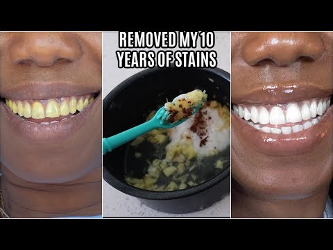 in two minutes remove 10 years of stains from teeth!! Results will Shock You
