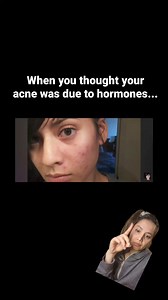 78K views · 129 reactions | LIFE LONG ACNE: GONE 凉 Since the age of...