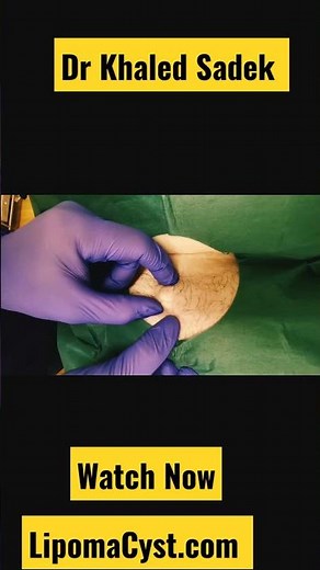 Bikini Line cysts are no fun. Dr Khaled Sadek. Full video online #cystremoval #blackheads #pimples