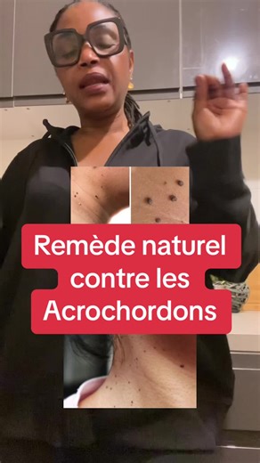 Remède naturel contre les Acrochordons - Vidéo authentique sans filtre