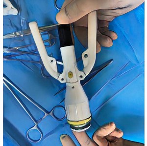 [Hot Item] Surgical Disposable Circumcision Stapler Forskin Device for Kit and Adults with Prepuce