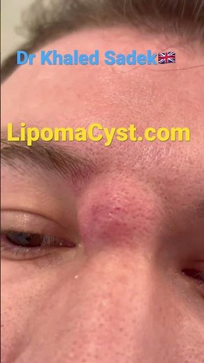 Massive face cyst removal Dr Khaled Sadek #acne #blackheadremoval #skinadvice LIPOMACYST clinic