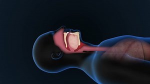 Sleep Apnea