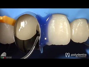Anterior direct composite restoration performed by Dr Manauta with Unica anterior matrix
