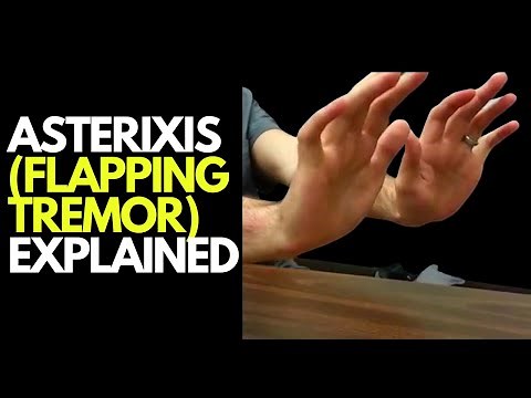 Flapping Tremor - Asterixis
