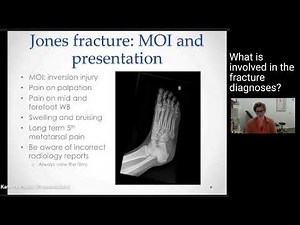 5th Metatarsal Fractures - Treatment & Diagnosis