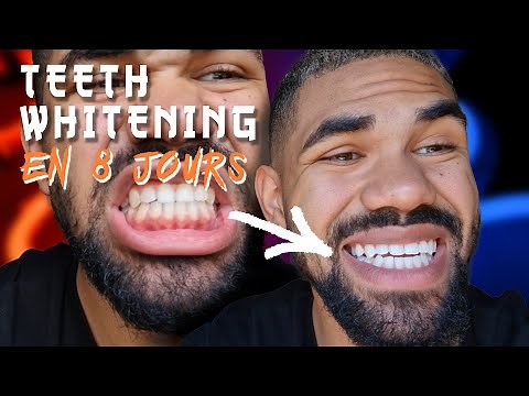 MON BLANCHIMENT DENTAIRE EN 8 JOURS | COMMENT AVOIR LES DENTS BLANCHES À LA MAISON | GOUTTIÈRES