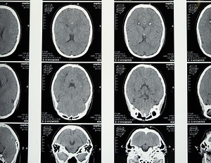 Everything you need to know about the 5-HT2B receptor