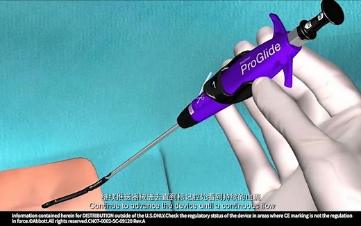 ProGlide血管缝合器单把操作步骤