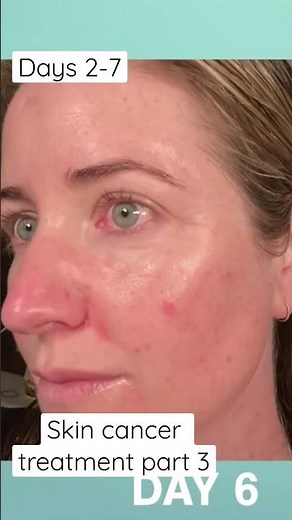 Days 2-7 of Fluorouracil treatment for skin cancer