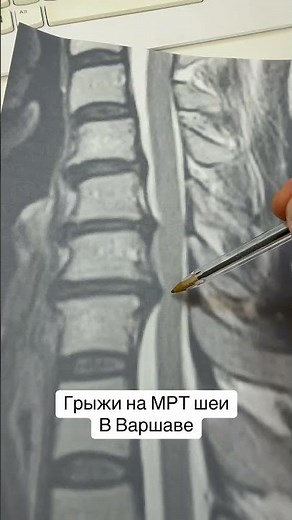 Where to get a cervical spine MRI in Warsaw
