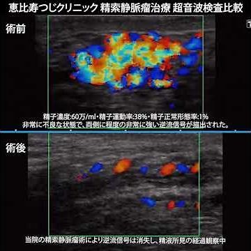 精索静脈瘤治療、超音波検査動画（恵比寿つじクリニック超音波検査動画 No.05） #恵比寿つじクリニック #男性不妊