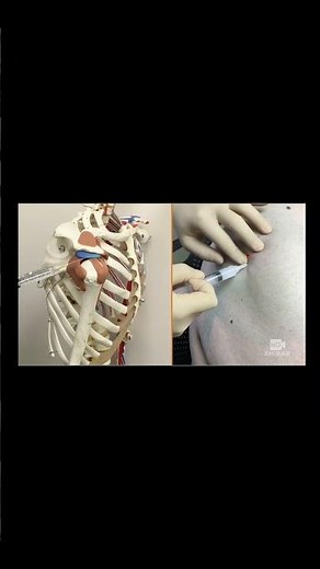 Subacromial Bursa Injection #meded #sportsmedicine #orthopedics