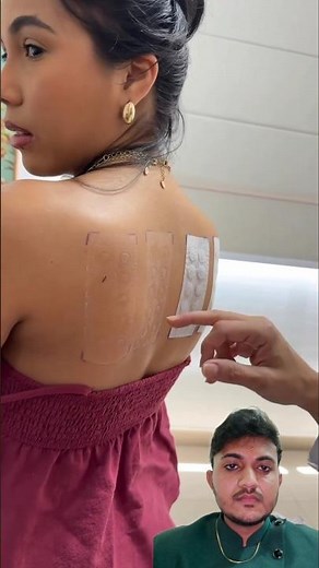 allergy patch test #skinallergy #patchtest #dermatitis #itching