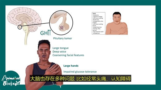 肢端肥大症 vs 巨人症：10分钟讲清生长激素相关疾病
