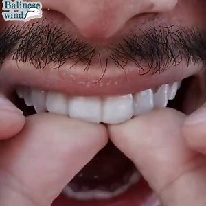 15K views · 232 reactions | Snap-On Smile est pour à peu près tout le monde! Snap-On Smile est une solution abordable et qui change la vie pour les personnes de tous âges. Obtenir un Snap-On Smile exige simplement deux courtes visites, indolore, sans perçage, aucun coup de feu et aucun changement dans la structure de la dent. | Cabinet Dentaire Dr. Ajmi Mehdi | Facebook
