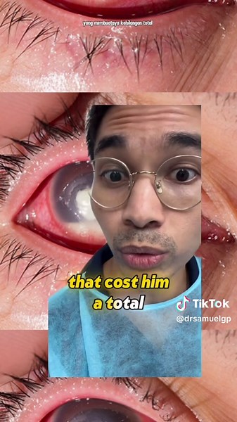 The Dangers of Contact Lenses: Eye Health Tips