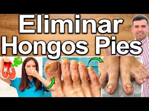 HOW TO REMOVE FOOT FUNGUS - ELIMINATE ATHLETE'S FOOT IN 1 WEEK - CAUSES AND SOLUTIONS