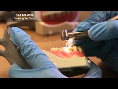 Full Gold Crown Prep on #30