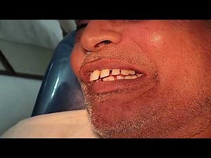 Painless removal of root stumps of 15,16 tooth #extraction #dentistry #painless #molars