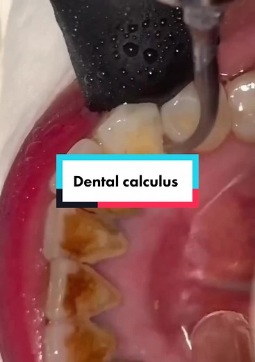 Bigsugar teeth on TikTok