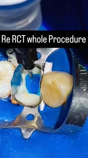 Re Rct procedure #dentist #shorts