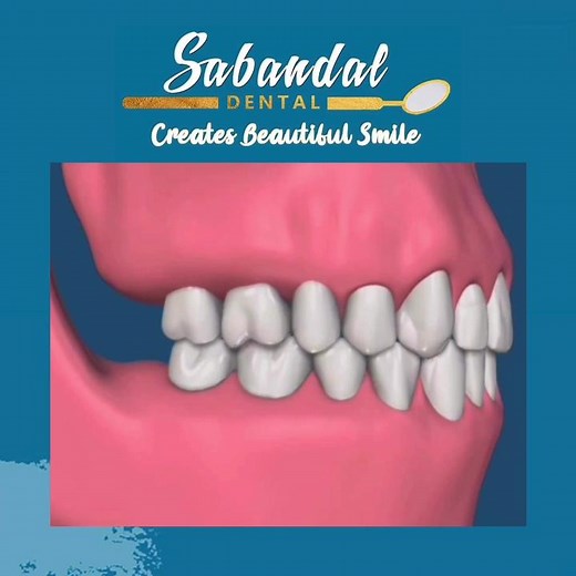 Tooth Super-Eruption: Causes, Effects, and Solutions