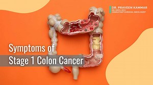 Symptoms of Stage 1 Colon Cancer for Early Prevention