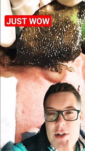 BEST PORE STRIP REMOVAL 2023 - Satisfying Blackhead Removal #shorts