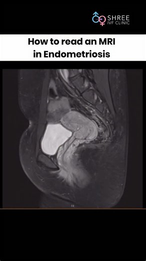 This is exactly how we try to read an MRI for a patient who has come to us for endometriosis. Though I am not a qualified radiologist., repeatedly looking at MRI gives us a visual and tactical awareness as to how to spot the disease and give an appropriate and adequate counselling for the patient. The biggest advantage of being a referral unit is, we are dead HONEST and as a result of this majority of the patients get a sound guidance of their disease. #drjaymehta #shreeivfclinic #endometriosis 