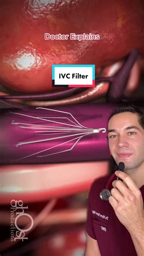 IVC Filter Explained: Preventing Pulmonary Embolism