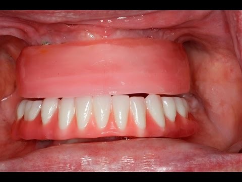 Step-by-Step All-on-Four Dentures: Part 3: Jaw Relations #allonx #allon4