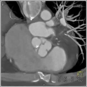 Cardiac: Dilated aortic root and sinuses of Valsalva (8 of 10)