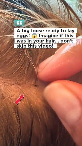 Sometimes one big louse can start hundreds more. Don’t wait until the itch gets worse — clean and care for your hair before it’s too late! 💆‍♀️✨ #HeadLice #LiceRemoval #HairCareTips #CleanHairJourney #LiceProblem #HealthyScalp #HairHygiene #FbLifestyle #LiceCheck | Ahmad