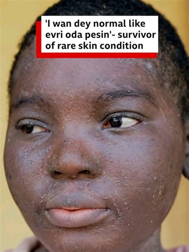 Dis rare skin condition dey come wit plenti body pain. Kosisochukwu Okafor na 20 year old girl wey dey battle skin condition wey dem dey call Psoriasis. Dis rare skin condition dey cause inflammation on skin, but e no dey contagious. She say na through tests and diagnosis she take sabi wetin e be and e dey painful. @kosisochukwu say dis skin condition pause her education and e dey worry her. Her wish na to get normal skin like oda pipo but she go kontiue to dey strong. Producer x edit: @TemFilms