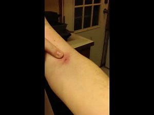 Infected Spider Bite
