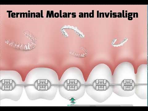 Terminal Molars and Invisalign- Tricks and Tips