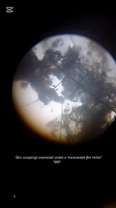 **Sarcoptic Mange** Sarcoptic mange, caused by the parasitic mite *Sarcoptes scabiei*, is a highly contagious skin disease affecting **animals** (e.g., dogs, foxes, cats, livestock) and humans (where it is called **scabies**). The mites burrow into the skin, triggering intense itching and inflammation. --- ### **Key Information** 1. **Causes**: - *Sarcoptes scabiei* mites, which infest the skin and lay eggs. - In animals, the subspecies *Sarcoptes scabiei var. canis* is common in dogs. 2. **Symp