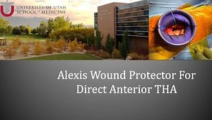 Technique and Benefits to Using Alexis Wound Protector During Direct Anterior Total Hips