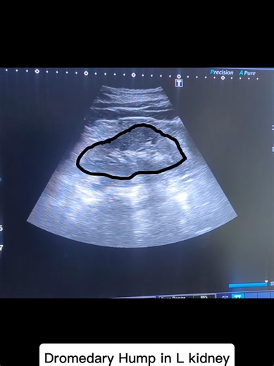 Dromedary Hump is normal variant in left kidney #kidneyultrasound #Educationalcontent #dromedaryhump #kidneyvariant #foryou
