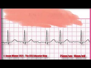 EKG Quiz: Identify the EKG rhythm/must know EKG/ECG Rhythms #quiz#ekg#ecg#rhythm#ekgrhythm#heart