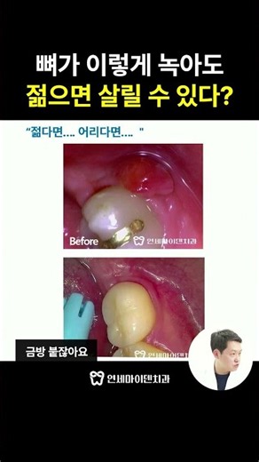 Teeth with Severe Bone Loss: Why Being Young is Important for Treatment