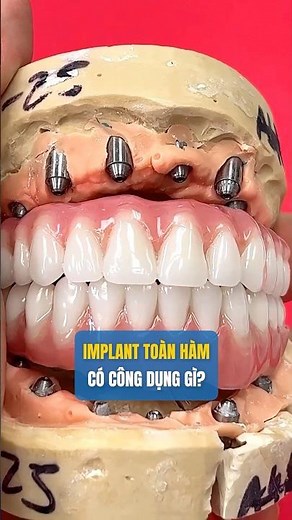 How many implants for a full-arch restoration? 4–6 implants for fixed teeth