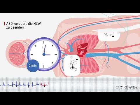 SCHILLER REANIMATION: Wie benutzt man einen AED