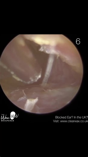 Ear Wax Removal & Dead Skin Peel Clinic - Part 3/3